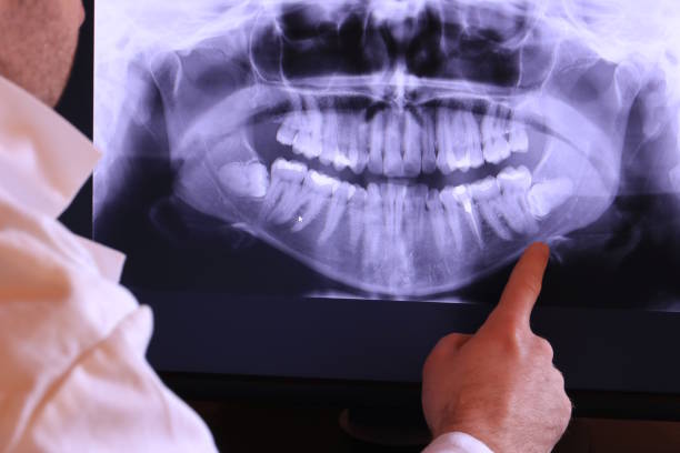 Best Knocked-Out Tooth (Avulsed Tooth) Treatment in Myrtle Beach, SC